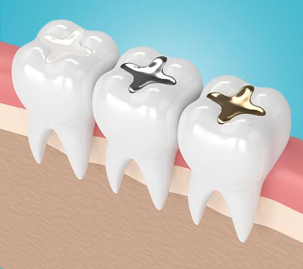 Roswell Composite Fillings