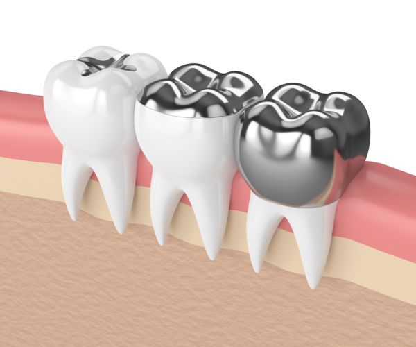Is The Dental Crown Procedure Painful?
