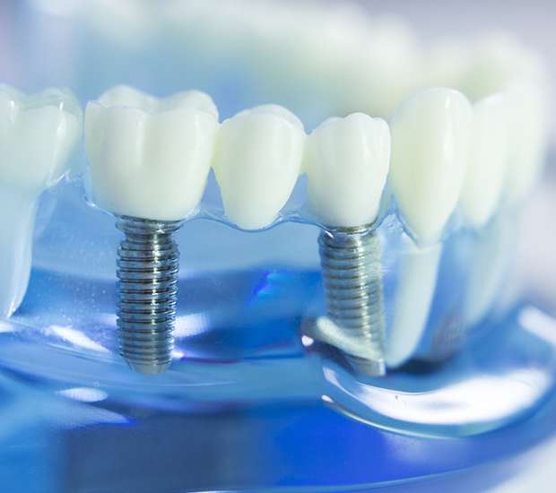 Roswell Dental Implants