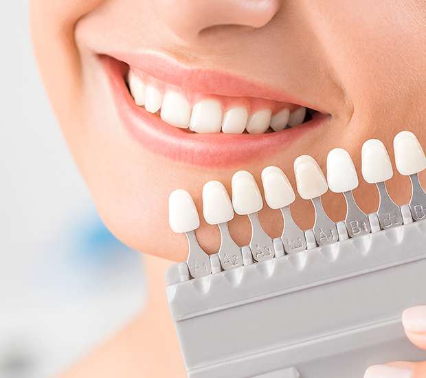 Roswell Dental Veneers and Dental Laminates