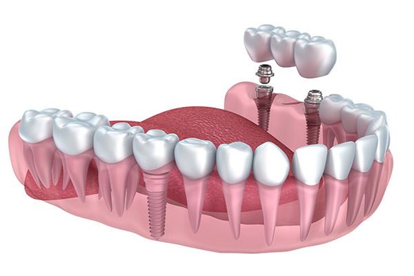 Exploring The Role Of Dental Implants In Tooth Replacement