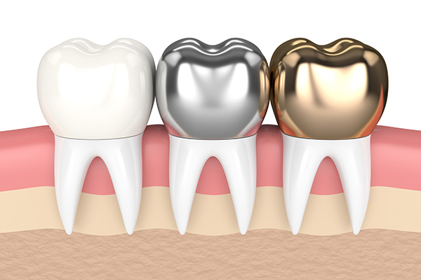 Metal Crowns vs. Porcelain Dental Crowns from Roswell Dental Smiles in Roswell, GA