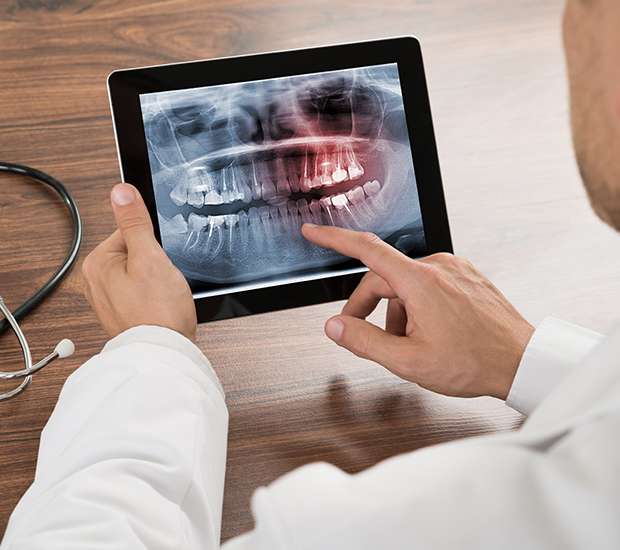 Roswell Types of Dental Root Fractures