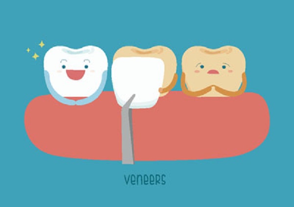 Dental Veneer Options [Cosmetic Dentistry]