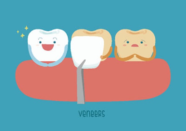 dental veneer Roswell, GA